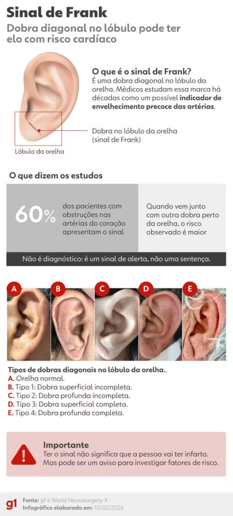 260210-info-sinal-de-frank-462x1024 Após morte de Henrique Maderite, médicos explicam a relação da dobra na orelha 'sinal de Frank' com risco de infarto